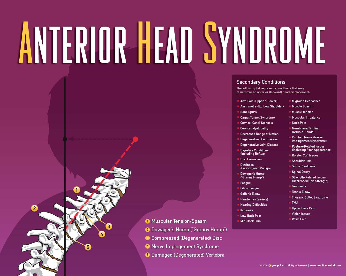 Anterior Head Syndrome in Vermont