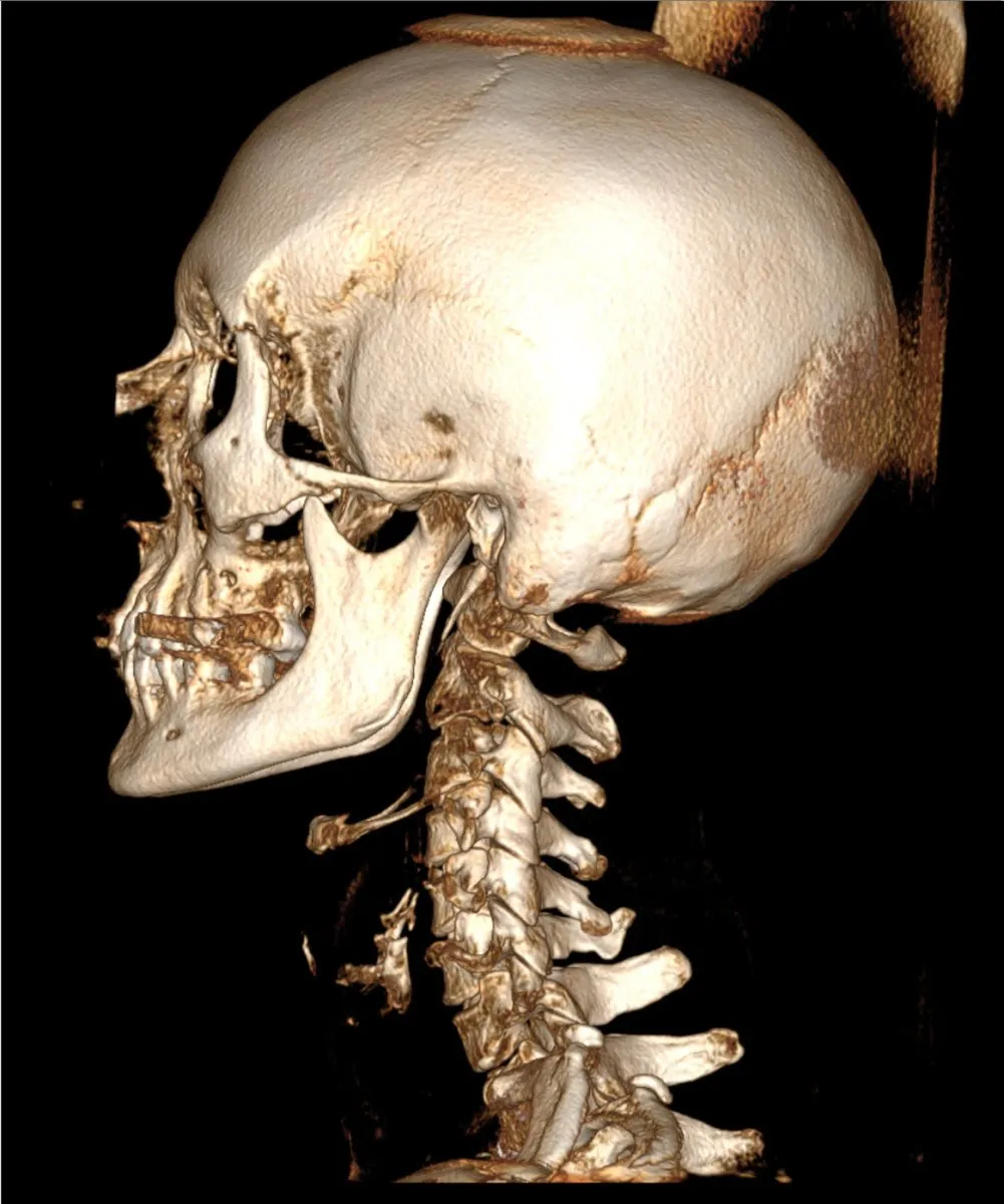 3D CBCT scan showing lateral view of the skull and cervical spine used for precise care at Precision Chiropractic in Williston, Vermont.