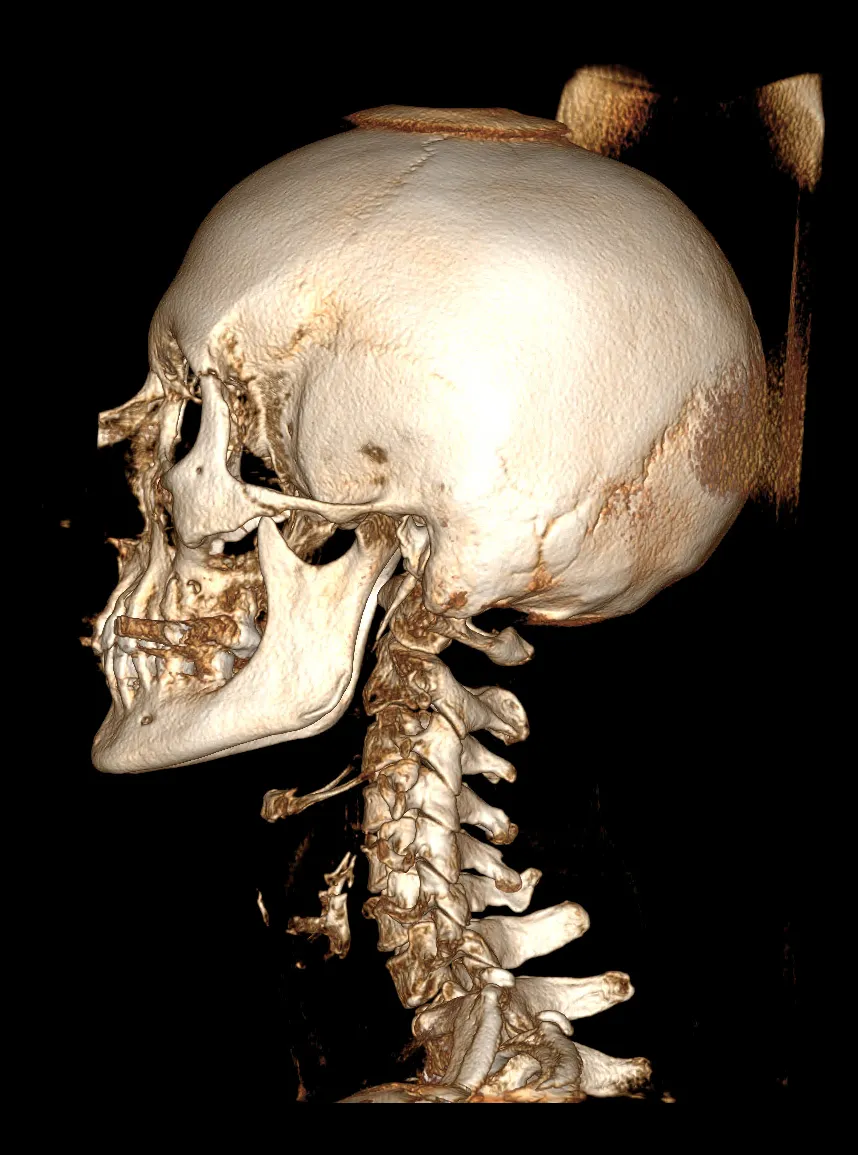 Side view 3D CBCT scan of skull and cervical spine used in upper cervical chiropractic analysis at Precision Chiropractic in Vermont