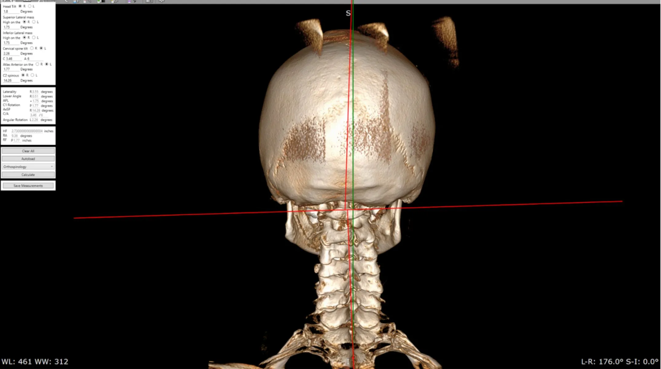 3D CBCT scan showing atlas misalignment and structural measurements for diagnosing the Atlas Displacement Complex at Precision Chiropractic in Vermont.