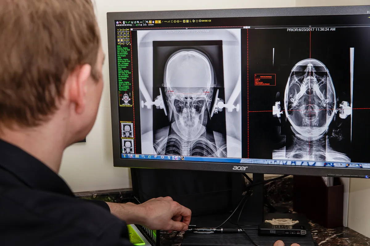 Dr. McCanse, Upper Cervical chiropractor reviewing axial CBCT scan to assess atlas and axis misalignment during diagnosis at Precision Chiropractic in Vermont