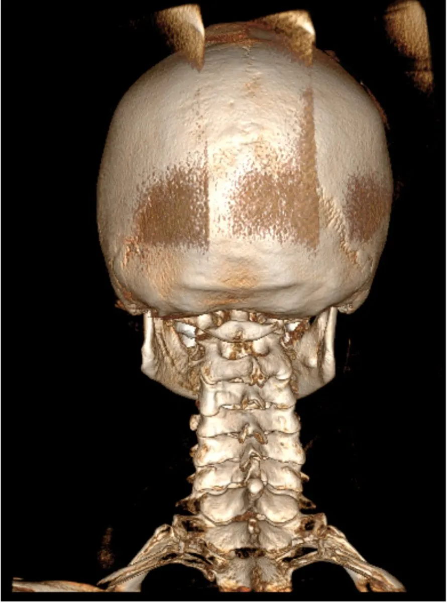 Posterior 3D Cone Beam CT scan of the upper cervical spine showing atlas and cervical vertebrae alignment for chiropractic assessment at Precision Chiropractic in Vermont